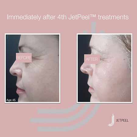 jetpeel_vorher-nachher_skin-institut_05.jpg 