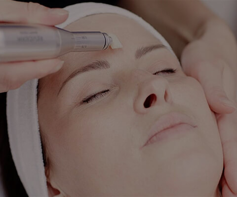 Microneedling, Kosmetik Hamburg, Skin Treatment Institut Hamburg