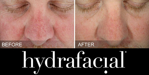 hydrafacial-vorher-nachher-01-skin-treatment-institut-hamburg.jpg 