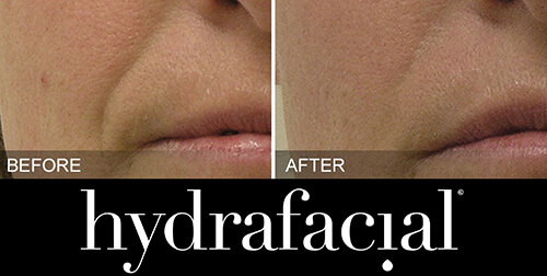 hydrafacial-vorher-nachher-03-skin-treatment-institut-hamburg.jpg 