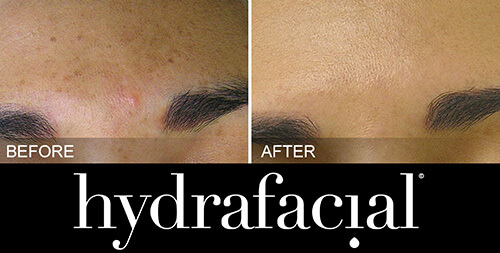 hydrafacial-vorher-nachher-04-skin-treatment-institut-hamburg.jpg 